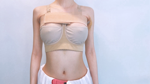 韩国profile普罗菲耳整形外科蓓拉假体隆胸术后第五天