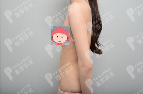 韩国profile普罗菲耳整形医院魔滴假体隆胸术前