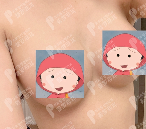 韩国profile普罗菲耳整形医院魔滴假体隆胸术后胸型