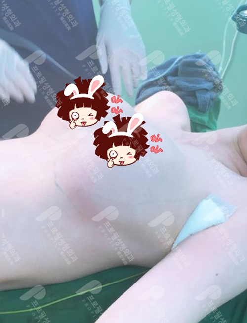 韩国profile普罗菲耳医院隆胸术后即刻