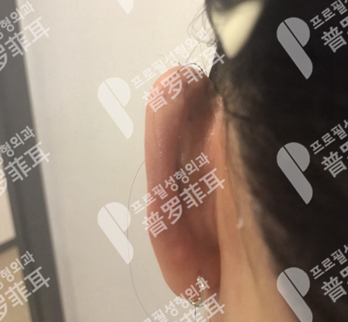 韩国profile普罗菲耳整形医院耳整形耳后疤痕