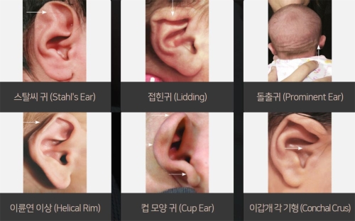 耳畸形常见种类