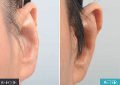 韩国profile普罗菲耳贴发耳治疗前后照片
