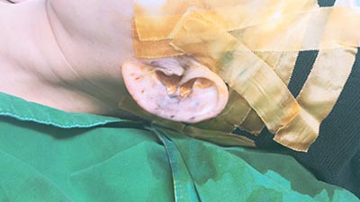 韩国profile普罗菲耳贴发耳治疗术后即刻