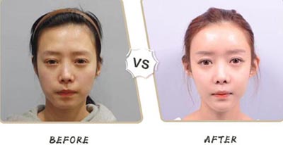 韩国profile普罗菲耳贴发耳治疗前后对比照片