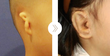 普罗菲耳耳整形手术案例