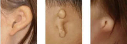 耳畸形种类图片