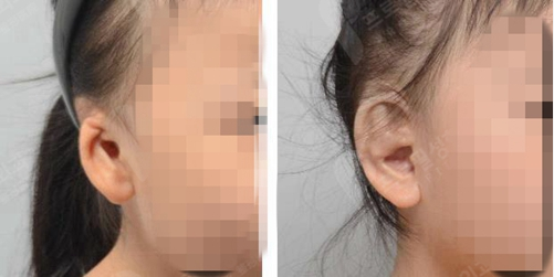 耳朵整形手术对比案例