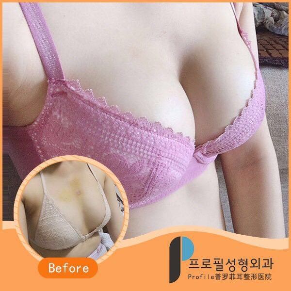 韩国profile普罗菲耳医院隆胸手术案例对比