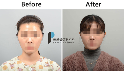韩国Profile普罗菲耳整形外科贴脑耳矫正案例