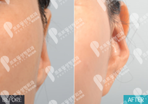 韩国Profile普罗菲耳医院贴脑耳术后实拍图