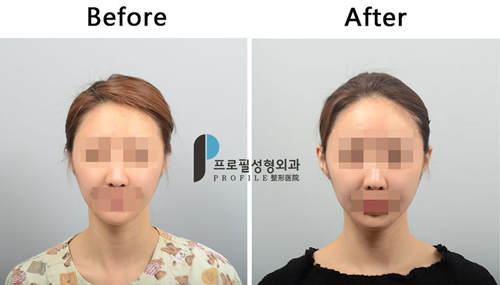 韩国Profile普罗菲耳医院贴脑耳术后案例图