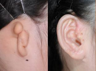小耳症是什么