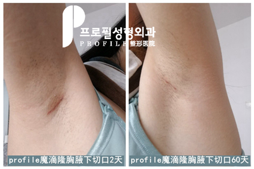 韩国普罗菲耳术后腋下疤痕实况