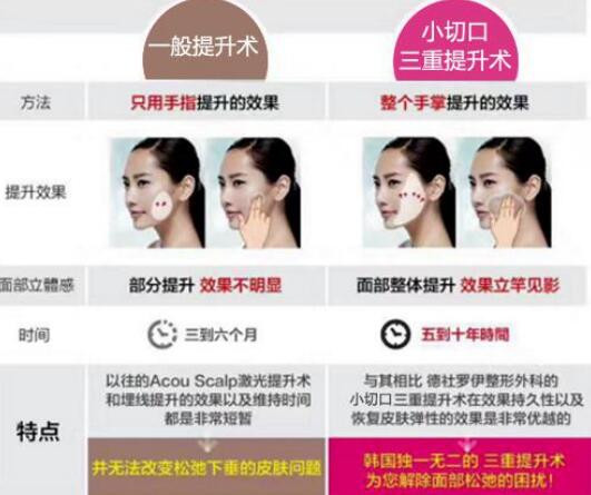 韩国profile普罗菲耳面部提升手术
