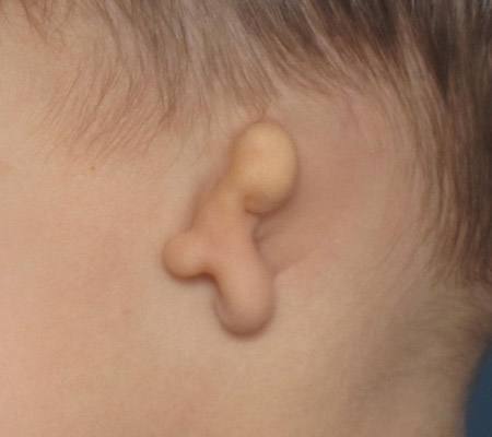 新生婴儿小耳症照片