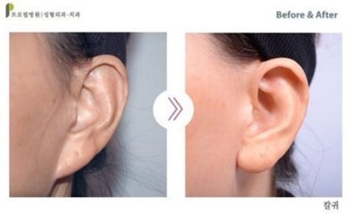 耳朵畸形听力能恢复吗