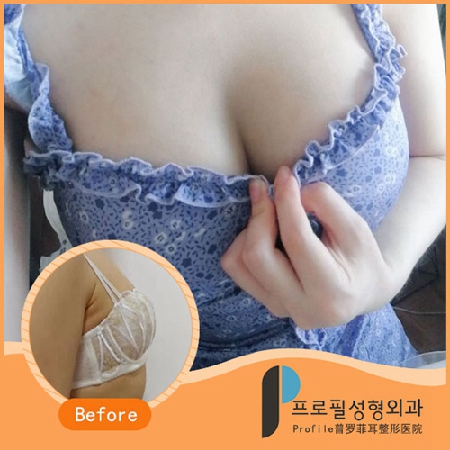韩国profile普罗菲耳魔滴假体隆胸术后真人案例