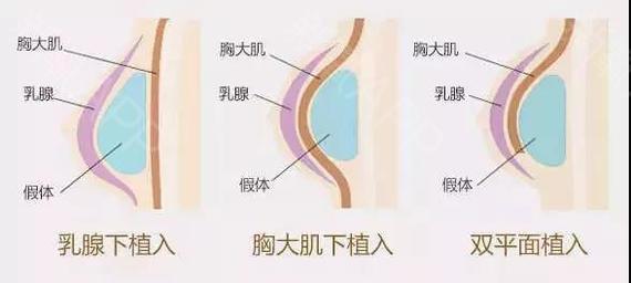 三种不同的假体隆胸方式