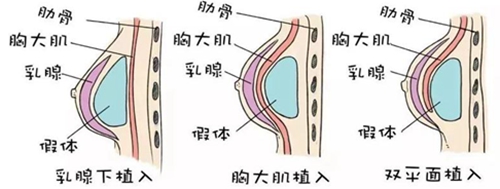 假体隆胸的三种不同的植入方式