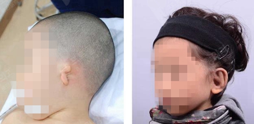 韩国profile普罗菲耳整形医院耳部再造术案例