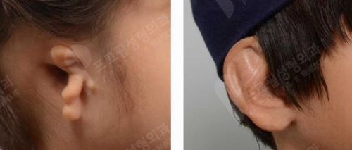 普罗菲耳郑在皓做耳再造手术用的人工支架是什么材料？靠谱吗？