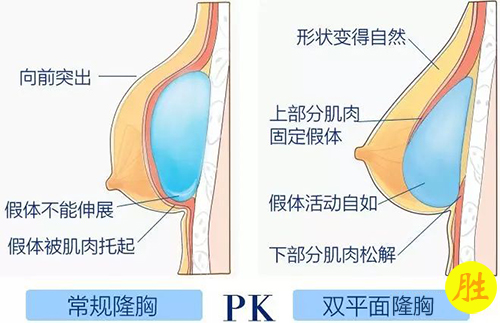 常规隆胸PK双平面隆胸