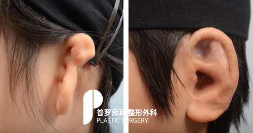 人工支架做外耳容易外露是真的吗？有没有办法规避？