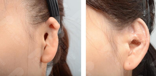 用人工支架做耳畸形矫正费用高吗？为什么不建议用义耳？