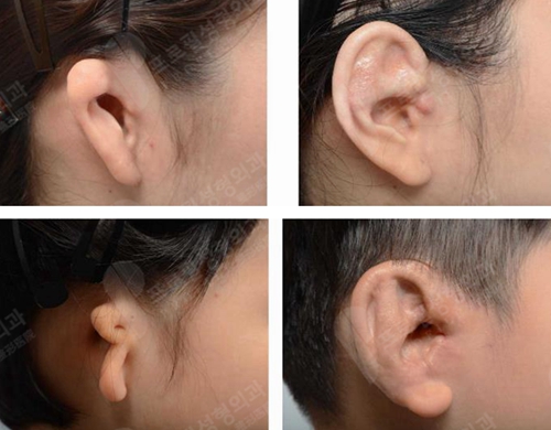 耳朵畸形是什么原因造成的？什么年龄做矫正手术合适？