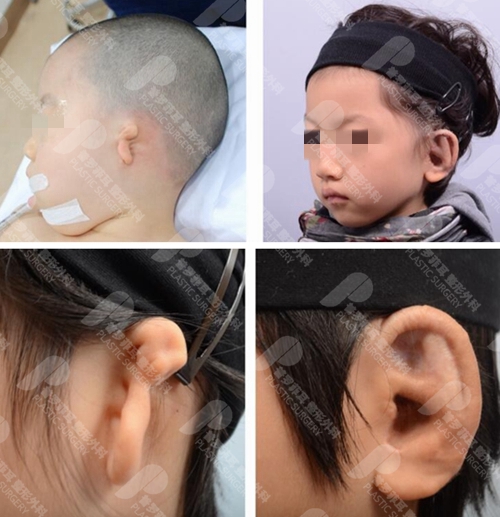 小耳畸形孩子多大做矫正合适？会留下什么后遗症吗？