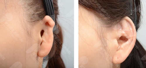 耳再造手术能恢复听力吗？郑在皓院长帮你同时实现听力＋外耳重建