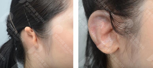 耳再造手术风险大吗？使用人工支架会不会有什么后遗症？