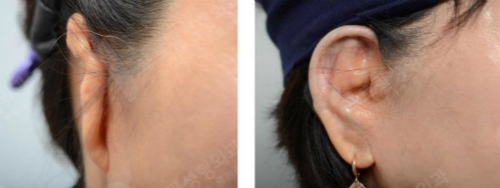 做耳再造手术时外耳重建和听力可以一起做吗，有什么好处？