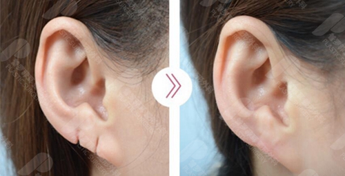 耳垂缺损修复要几岁才能做？手术会有什么后遗症吗？