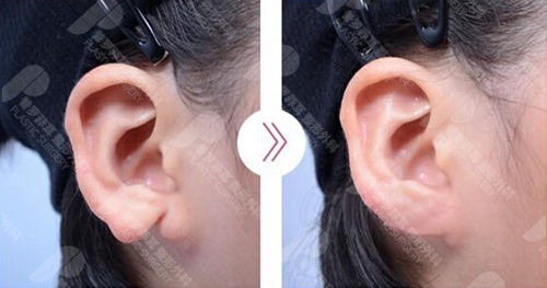 做耳垂再造手术多少钱能做？术后疤痕明显吗？