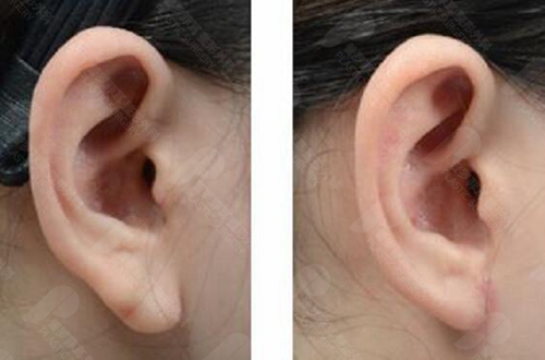 耳垂缩小手术前后对比照