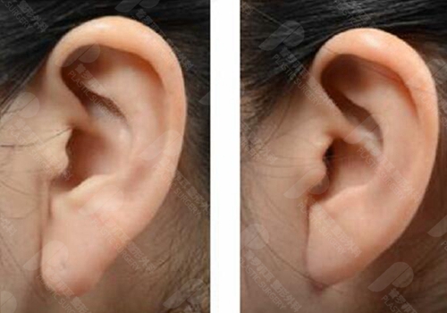 耳垂缩小手术真人案例