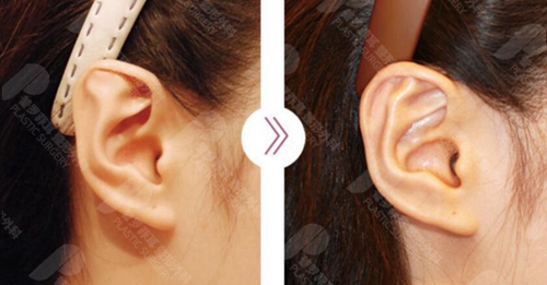 耳廓轻微畸形什么时候矫正合适？得花多少钱？