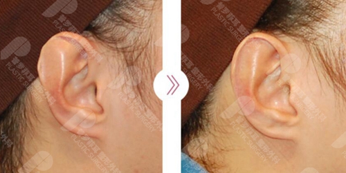 韩国普罗菲耳耳廓轻微畸形矫正案例