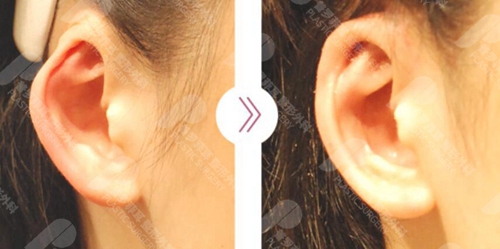 韩国普罗菲耳耳廓轻微畸形矫正前后对比图
