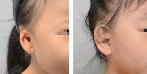 韩国普罗菲耳耳畸形矫正案例