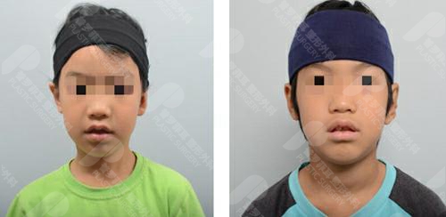 韩国普罗菲耳耳畸形矫正前后对比图