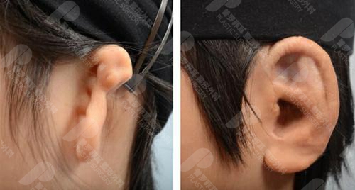 用人工支架做小耳畸形矫正手术后，再造的耳朵容易变形吗？