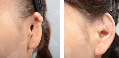 韩国普罗菲耳耳畸形矫正案例对比图