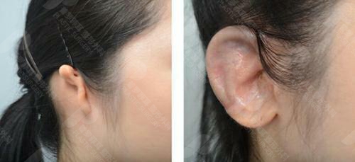 孩子小耳畸形，做全耳再造手术会留下疤痕吗？