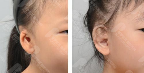 先天性小耳畸形同时患有听力障碍，做耳再造手术能改善吗？