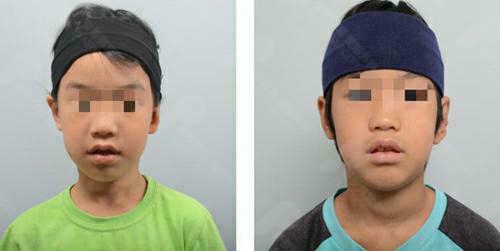 韩国普罗菲耳小耳畸形矫正前后对比图