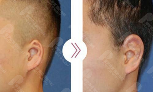 韩国普罗菲耳外耳廓缺损矫正真人案例