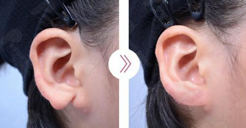 韩国普罗菲耳外耳廓缺损矫正前后对比图